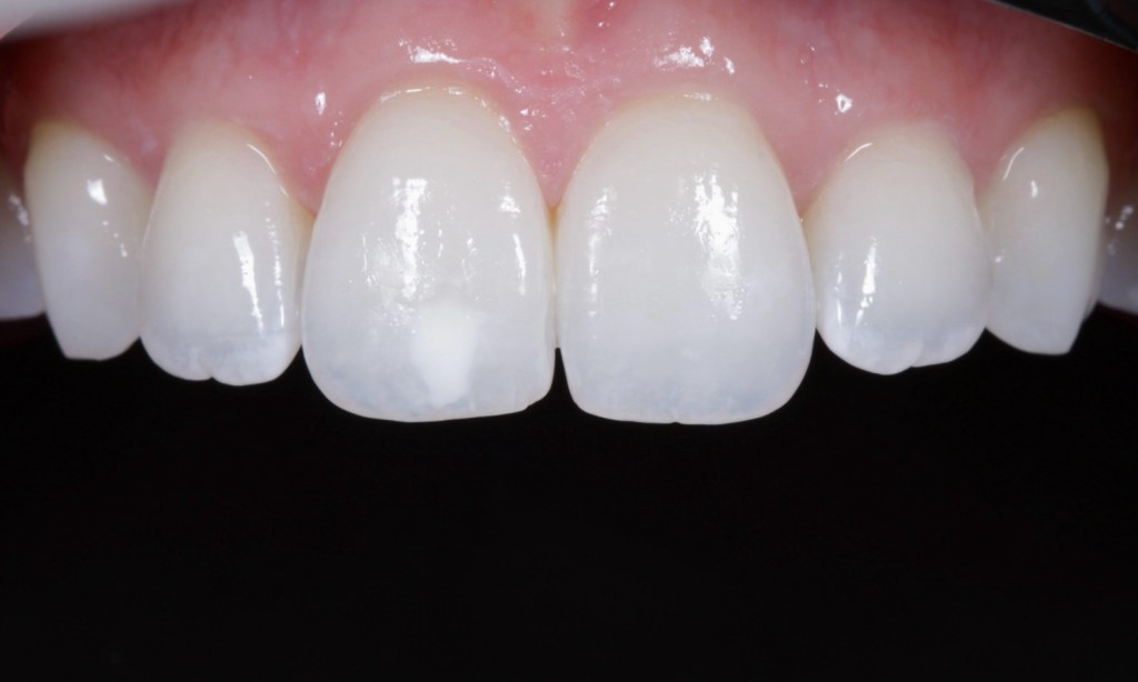 Resina infiltrativa: tratar manchas brancas sem desgastar o&nbsp;dente